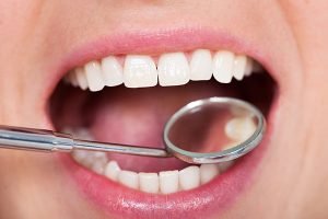 Close-up of a patient's open mouth with healthy teeth and a dental mirror being used for examination in a dental practice setting.
