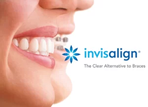 invisalign