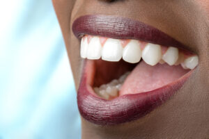 woman with wide tooth smile