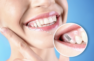smile with dental implant